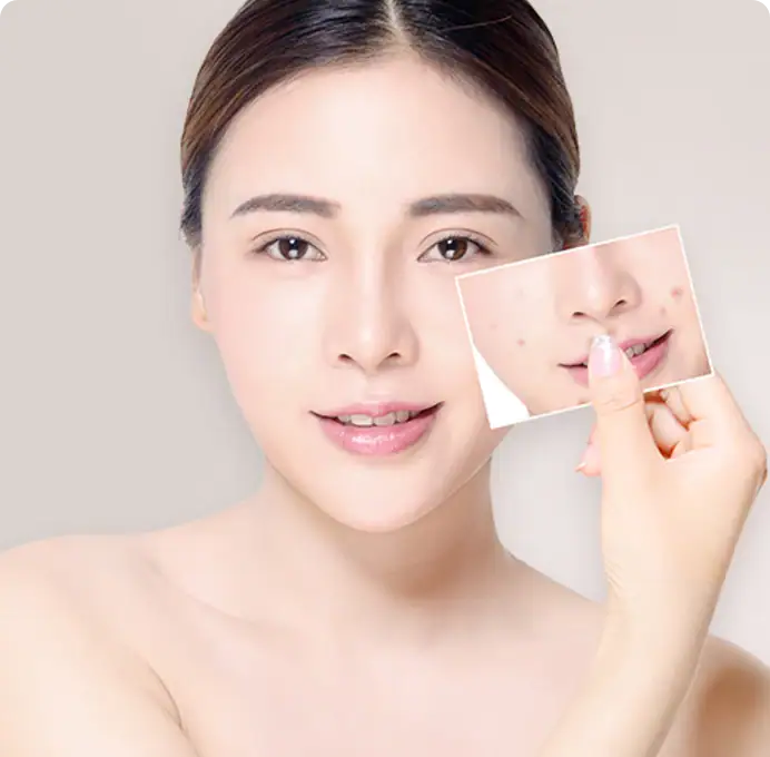 Woman holding a photo of her face showing acne, demonstrating skincare or acne treatment.