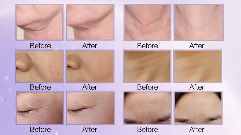 Comparison images showing skin improvement before and after using the OSANO 7D Pro MFU & HIFU machine for anti-aging.
