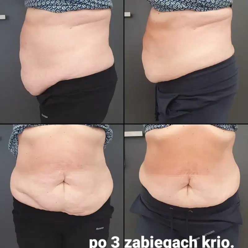 Comparison of abdominal area showing significant fat reduction and skin tightening after treatment at OSANO.