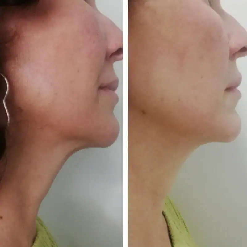 Side-by-side comparison of skin improvement showing reduced pigmentation and smoother skin texture after treatment.